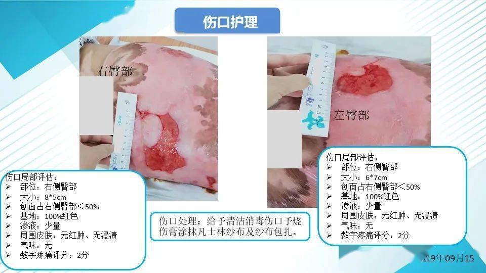 急性阑尾炎手术后的护理_急性会厌炎护理查房_急性阑尾炎的症状